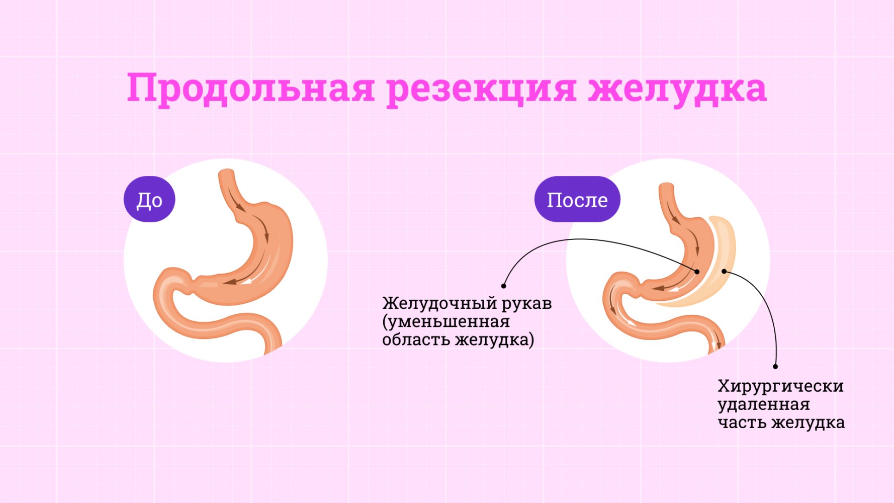 Что такое бариатрия и как ее делают?