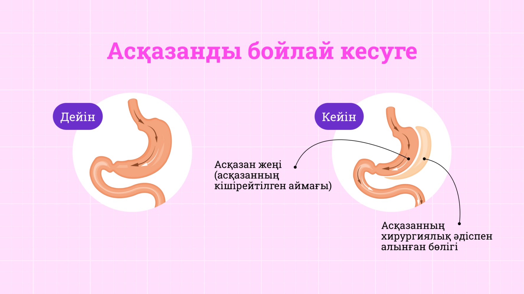 Бариатрия дегеніміз не және оны қалай жасайды?